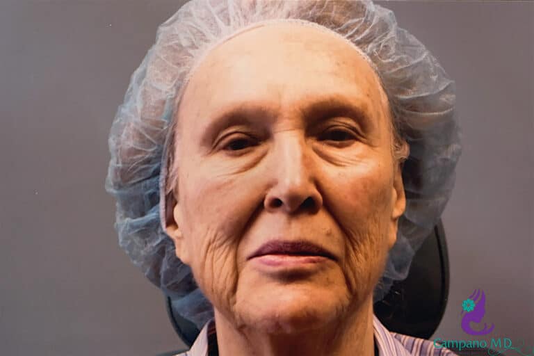 Before Image: CO2 Laser Resurfacing - front
