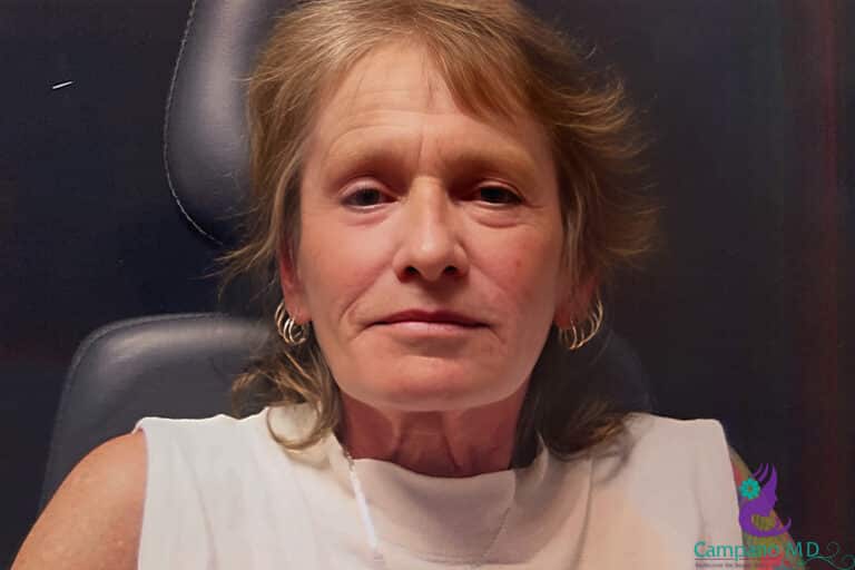 After Image: CO2 Laser Resurfacing - front
