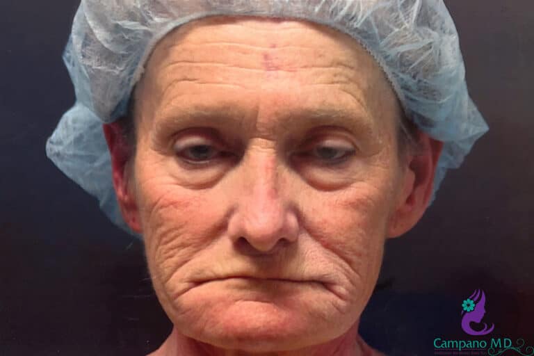 Before Image: CO2 Laser Resurfacing - front