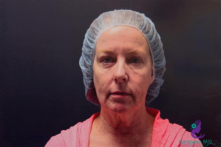 Before Image: CO2 Laser Resurfacing - front