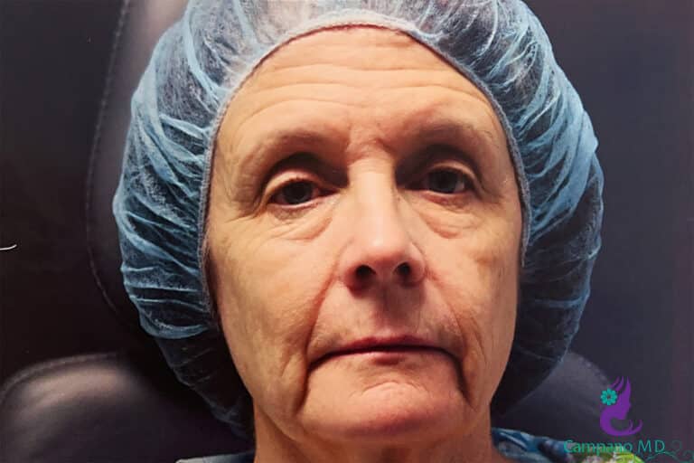 Before Image: CO2 Laser Resurfacing - front