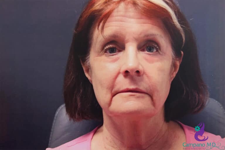 After Image: CO2 Laser Resurfacing - front